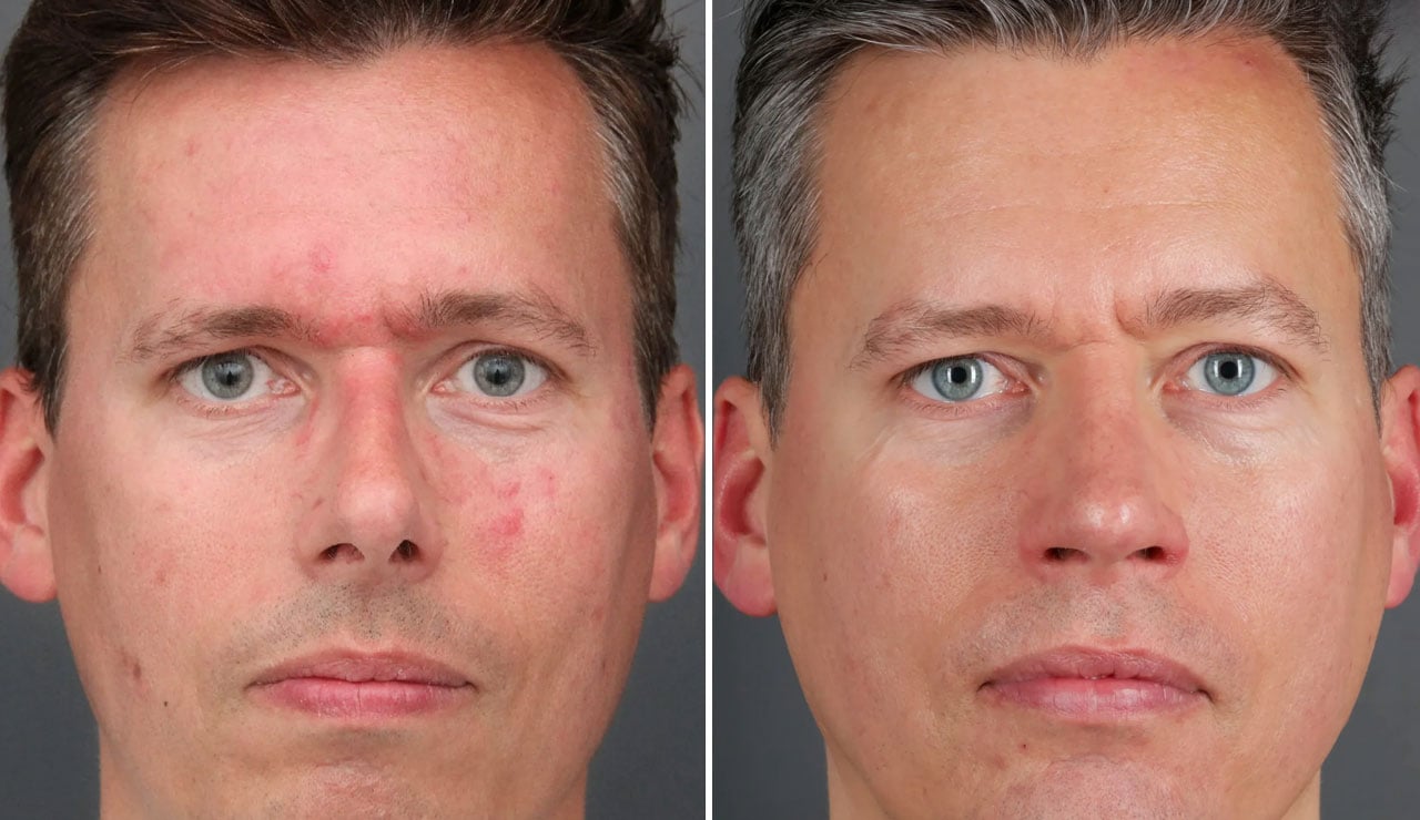 Mens RF Microneedling Before After