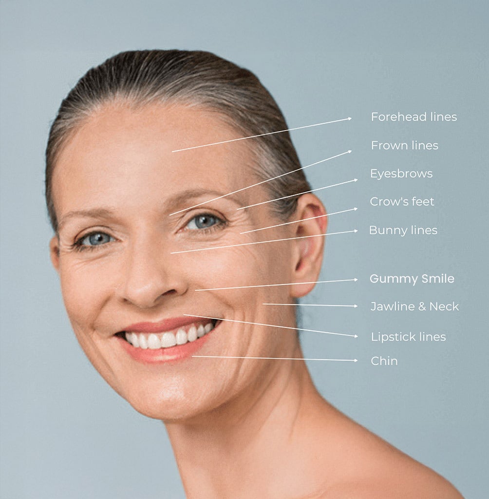 areas on the face that botox treats