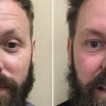 before and after plasma pen treatment for mens face