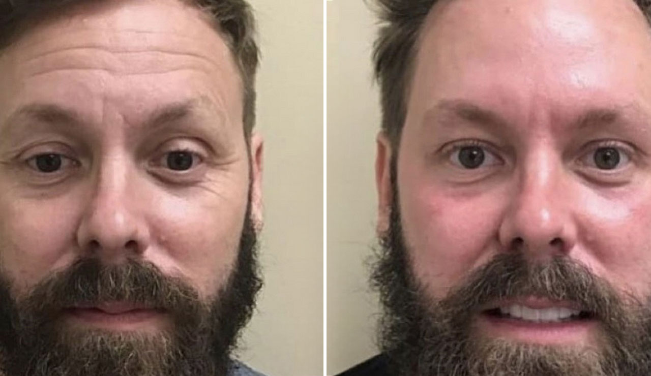 before and after plasma pen treatment for mens face