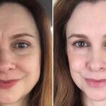 woman's plasma pen before and after of face