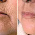 before and after of plasma pen treatment around mouth wrinkles