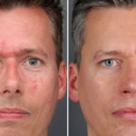 Mens RF Microneedling Before After