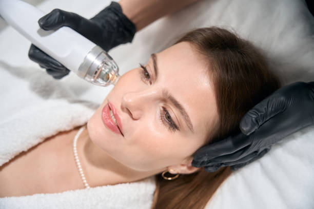 RF Microneedling Treatment