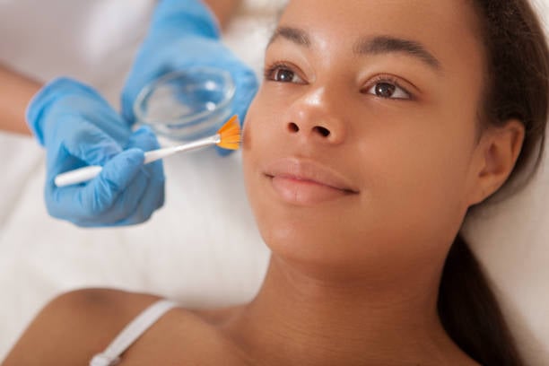 Affordable Chemical Peels Near Me in Phoenix
