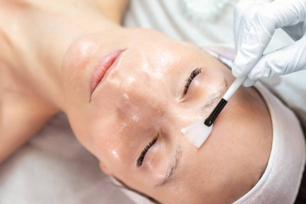 Chemical Peels for Dull Skin