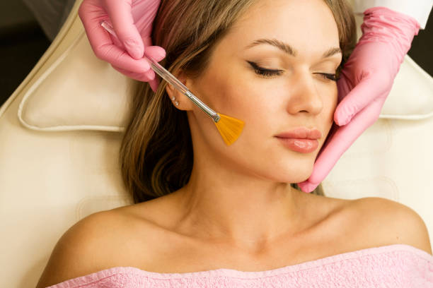 Chemical Peels in Phoenix, AZ