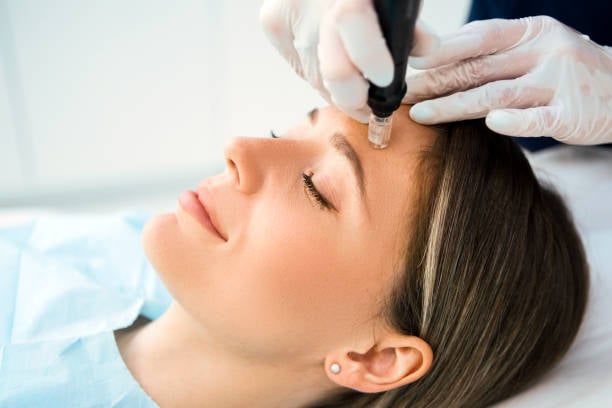 Microneedling in Phoenix