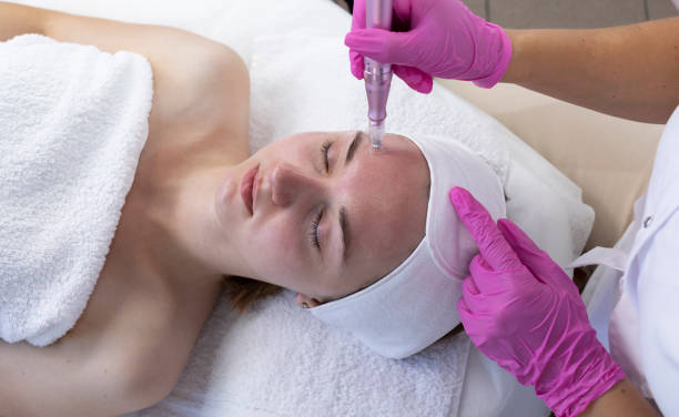 Skinpen Microneedling