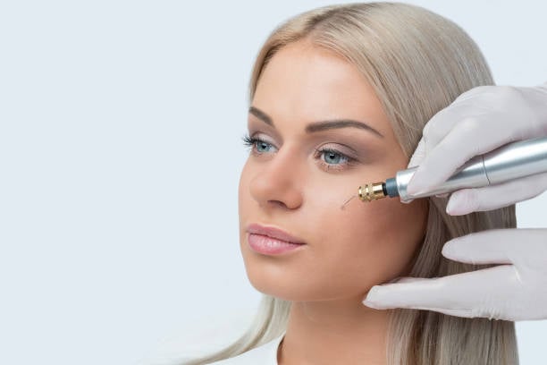 Subnovii Plasma Pen Treatment for Fine Lines