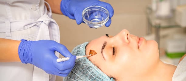 Chemical Peel Aftercare Phoenix