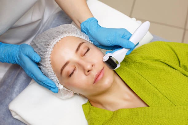 Microneedling for Acne Scars