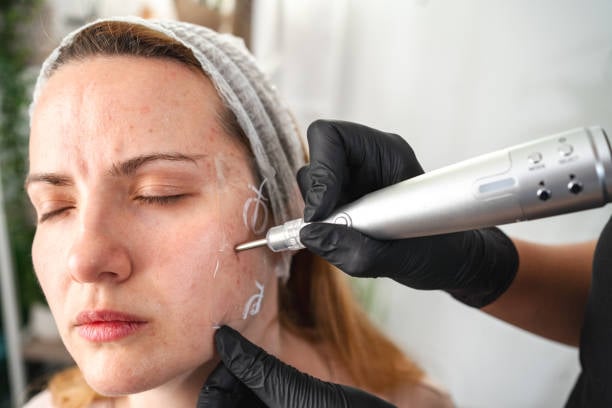 Plasma Pen Treatment Phoenix